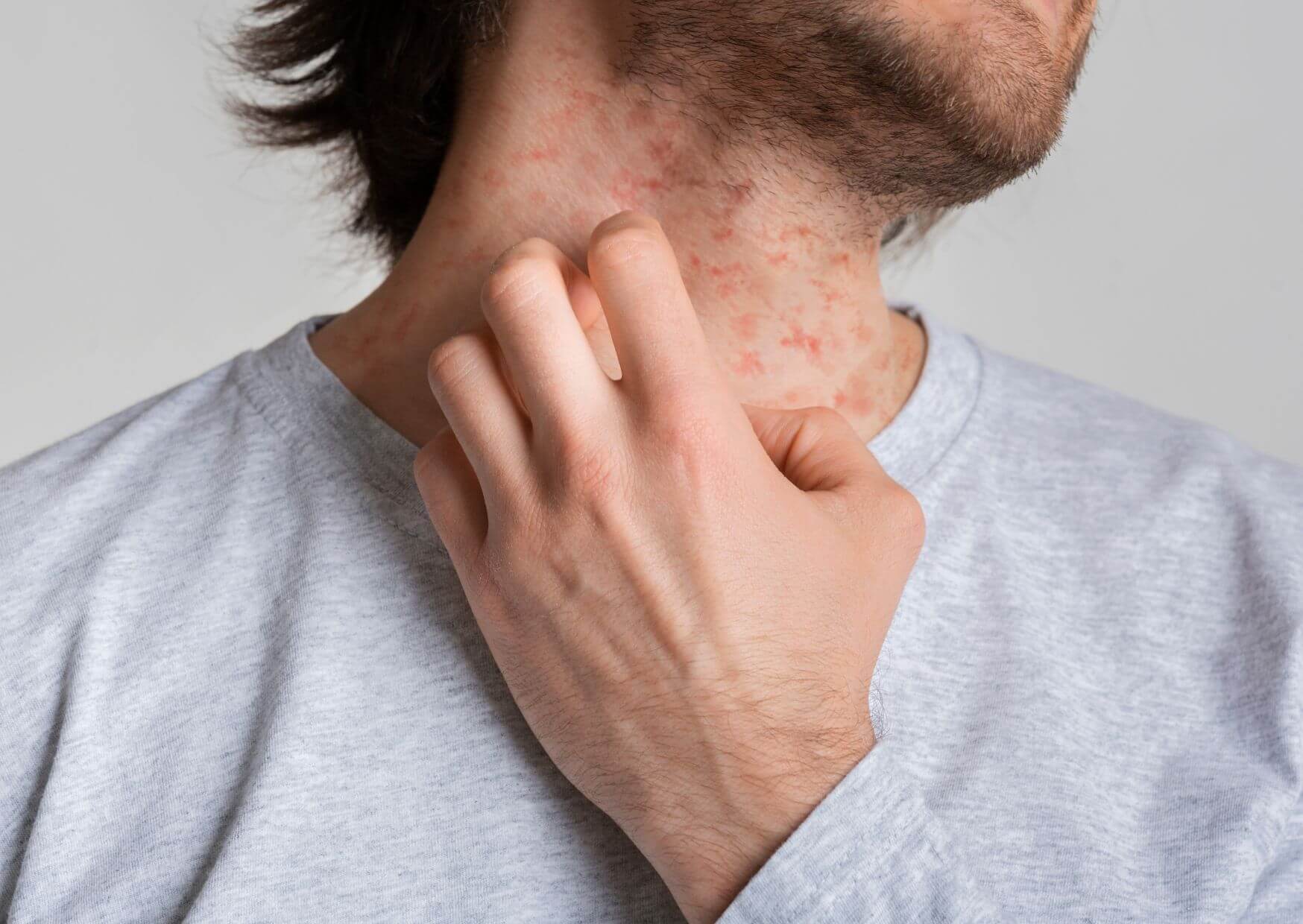 Managing Eczema