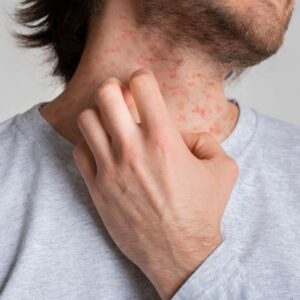 Managing Eczema